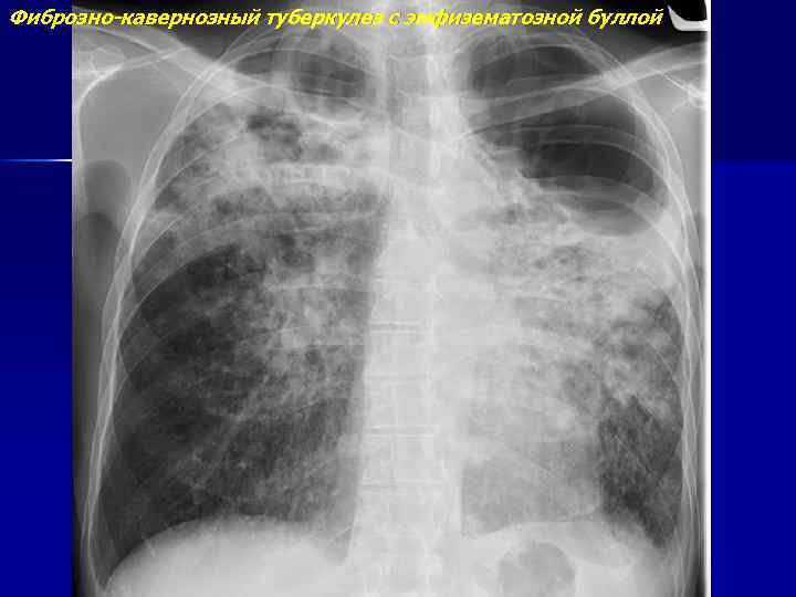 Фиброзно-кавернозный туберкулез с эмфизематозной буллой 