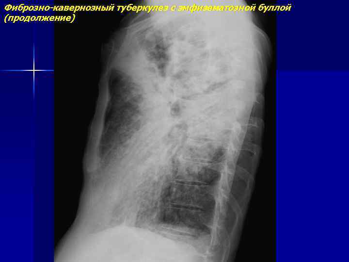 Фиброзно-кавернозный туберкулез с эмфизематозной буллой (продолжение) 