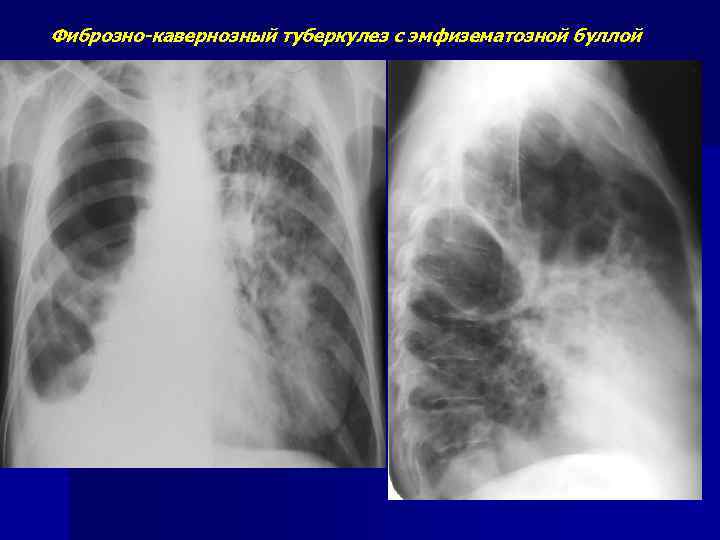 Туберкулома легких картинки