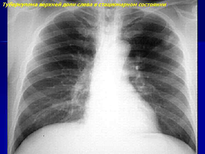 Туберкулома верхней доли слева в стационарном состоянии 