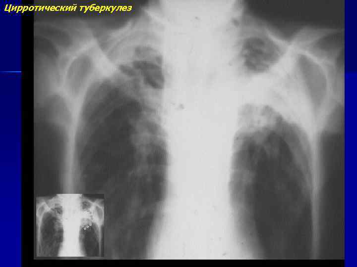 Цирротический туберкулез легких рисунок