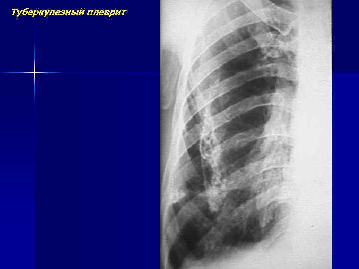 Туберкулезный плеврит 
