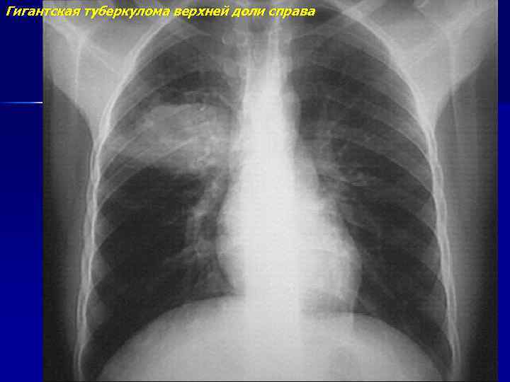 Гигантская туберкулома верхней доли справа 