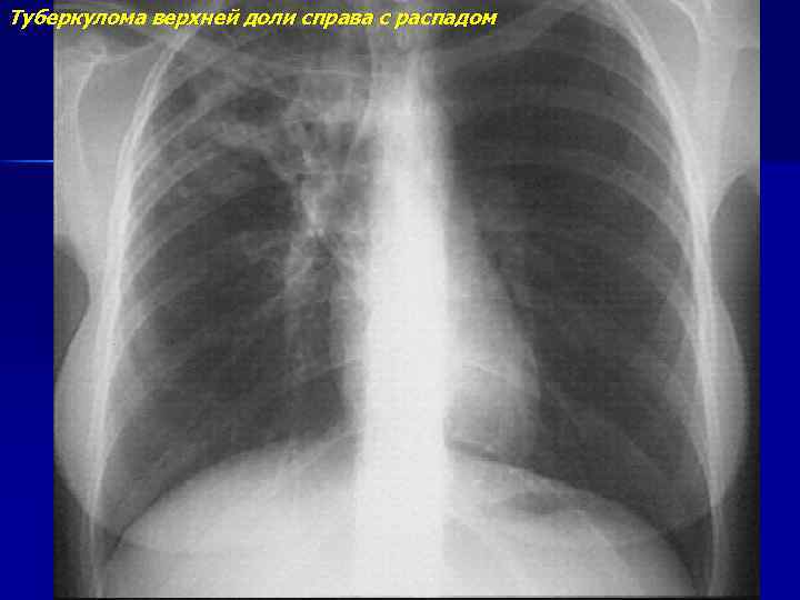 Туберкулома верхней доли справа с распадом 