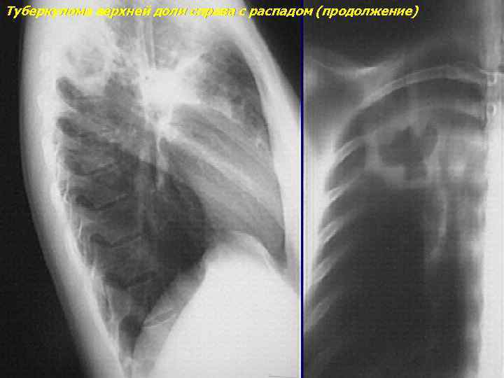 Туберкулома верхней доли справа с распадом (продолжение) 