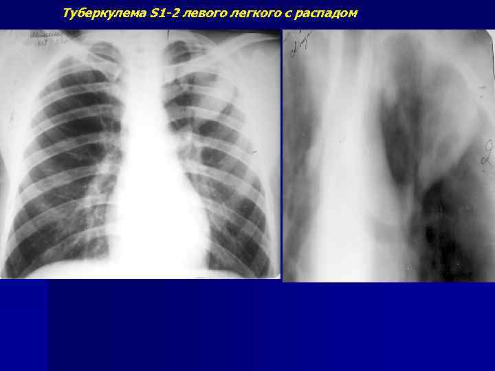 Туберкулема S 1 -2 левого легкого с распадом 
