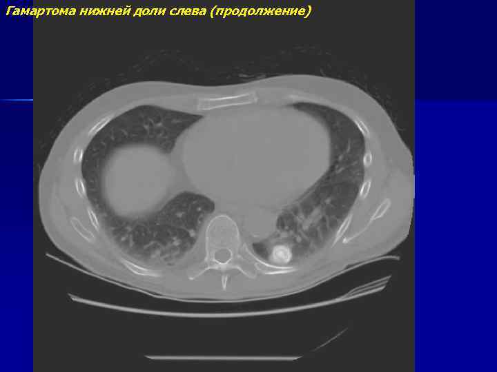 Гамартома нижней доли слева (продолжение) 