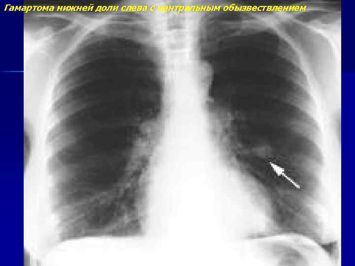 Гамартома нижней доли слева с центральным обызвествлением 