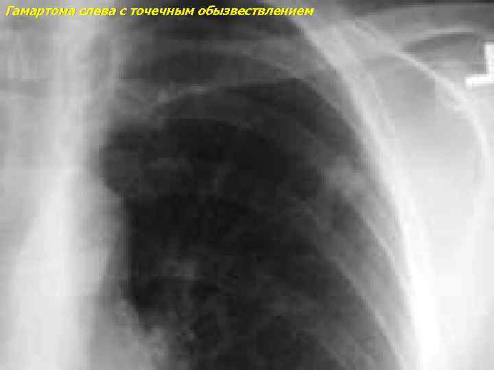 Гамартома слева с точечным обызвествлением 