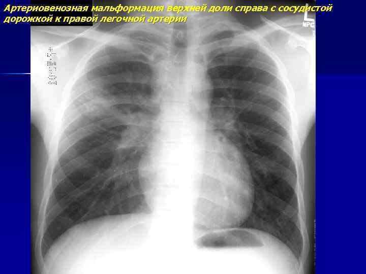 Артериовенозная мальформация верхней доли справа с сосудистой дорожкой к правой легочной артерии 