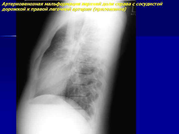 Артериовенозная мальформация верхней доли справа с сосудистой дорожкой к правой легочной артерии (приложение) 