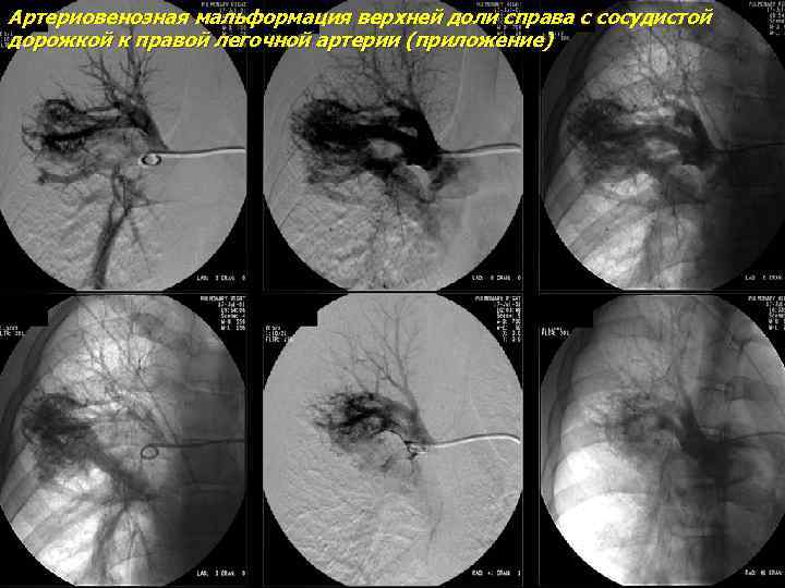 Артериовенозная мальформация верхней доли справа с сосудистой дорожкой к правой легочной артерии (приложение) 