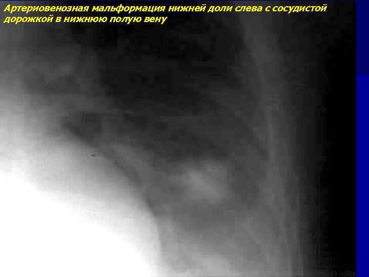 Артериовенозная мальформация нижней доли слева с сосудистой дорожкой в нижнюю полую вену 