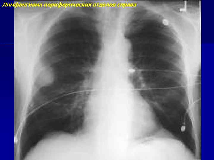 Лимфангиома периферических отделов справа 