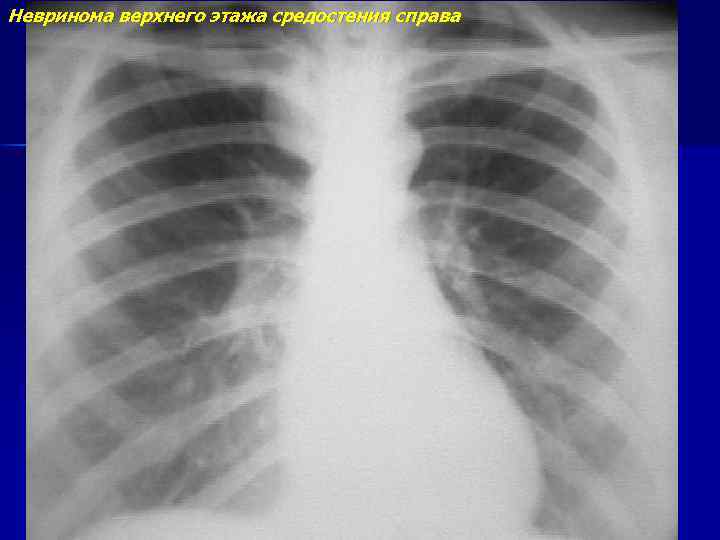 Невринома верхнего этажа средостения справа 