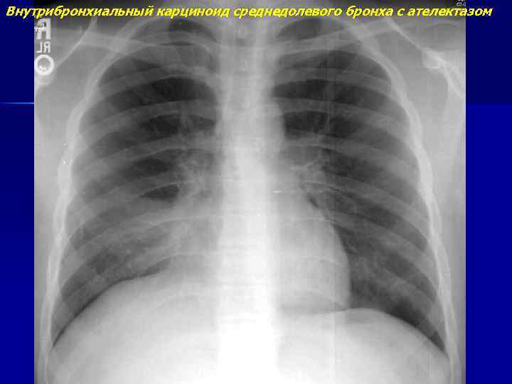Внутрибронхиальный карциноид среднедолевого бронха с ателектазом 