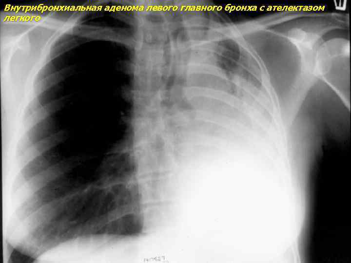 Внутрибронхиальная аденома левого главного бронха с ателектазом легкого 