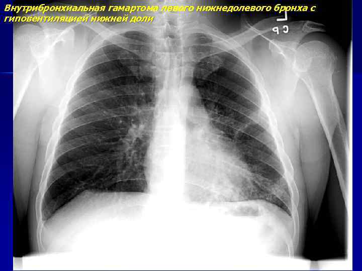 Внутрибронхиальная гамартома левого нижнедолевого бронха с гиповентиляцией нижней доли 