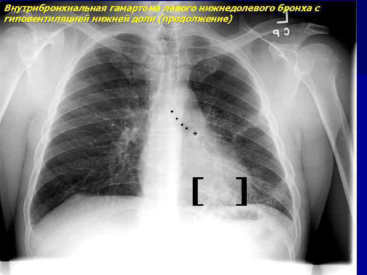 Внутрибронхиальная гамартома левого нижнедолевого бронха с гиповентиляцией нижней доли (продолжение) 