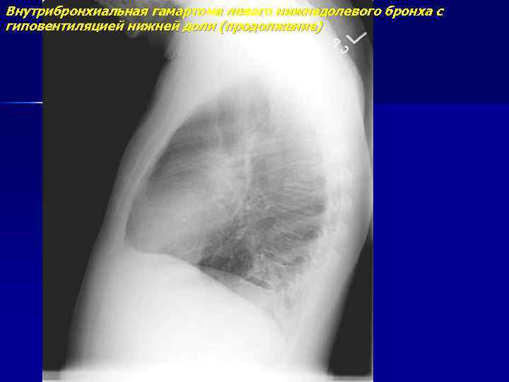 Внутрибронхиальная гамартома левого нижнедолевого бронха с гиповентиляцией нижней доли (продолжение) 