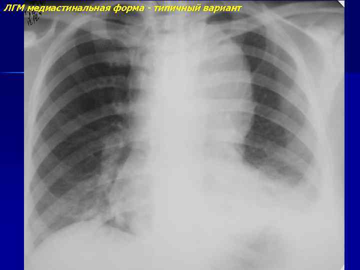 ЛГМ медиастинальная форма - типичный вариант 