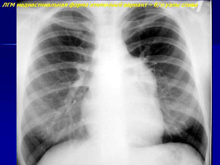 ЛГМ медиастинальная форма атипичный вариант – б/п узлы слева 