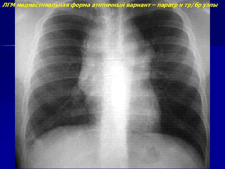 ЛГМ медиастинальная форма атипичный вариант – паратр и тр/бр узлы 
