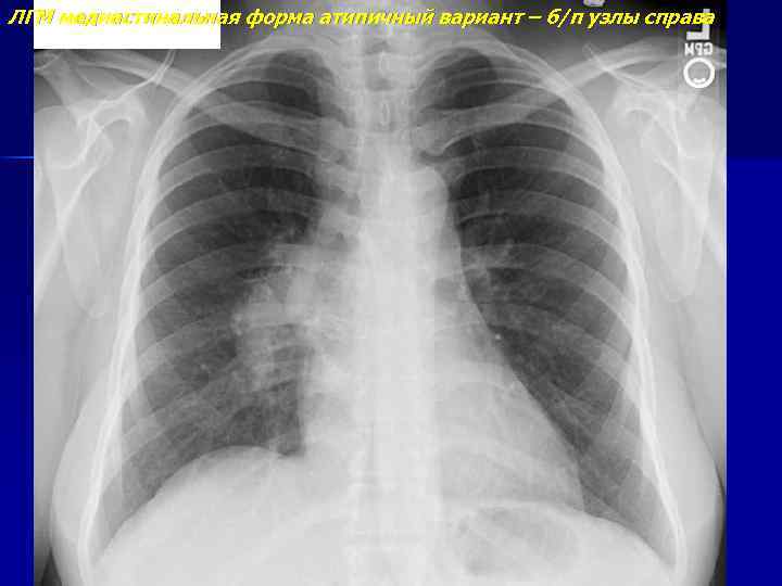 ЛГМ медиастинальная форма атипичный вариант – б/п узлы справа 