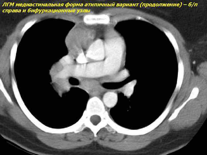ЛГМ медиастинальная форма атипичный вариант (продолжение) – б/п справа и бифуркационные узлы 