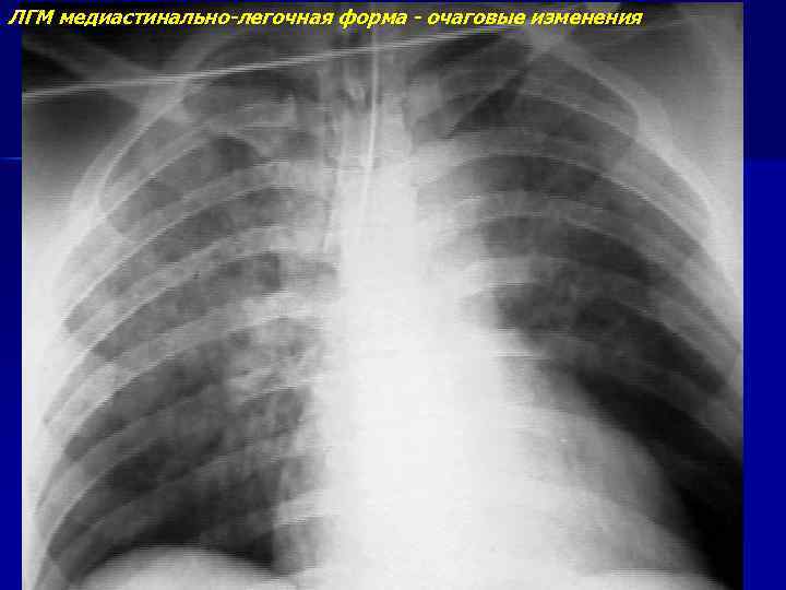 ЛГМ медиастинально-легочная форма - очаговые изменения 