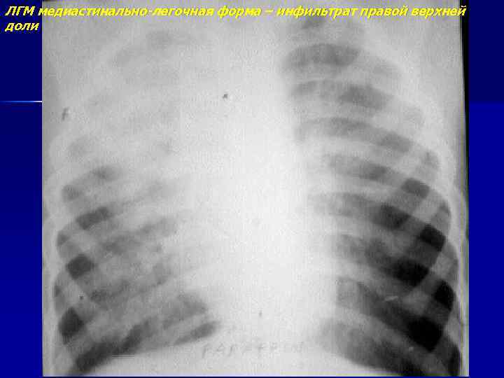 ЛГМ медиастинально-легочная форма – инфильтрат правой верхней доли 