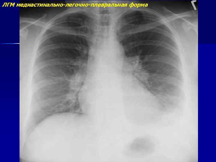 ЛГМ медиастинально-легочно-плевральная форма 