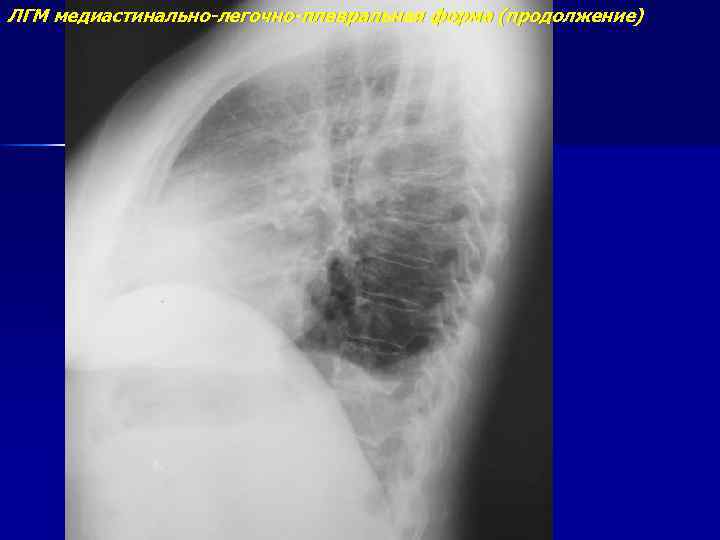 ЛГМ медиастинально-легочно-плевральная форма (продолжение) 