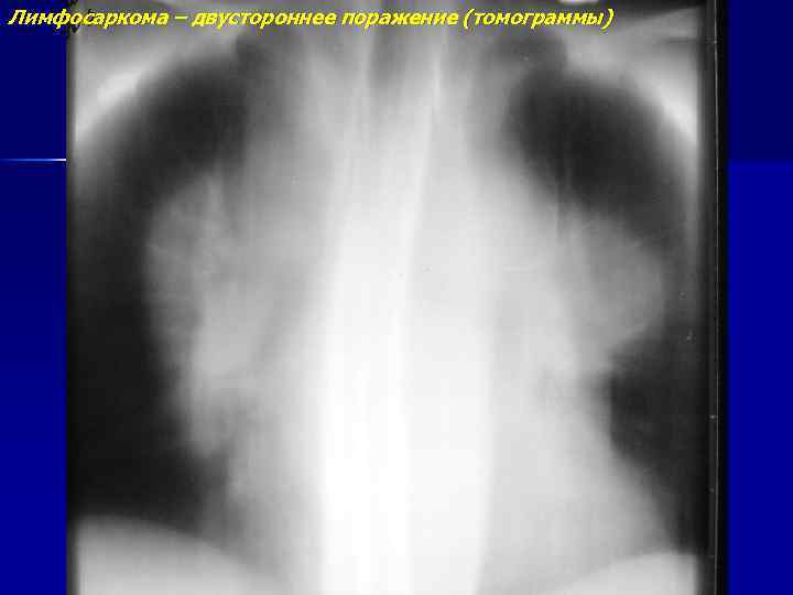 Лимфосаркома – двустороннее поражение (томограммы) 