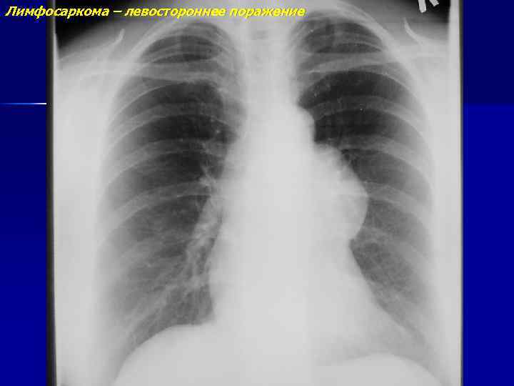 Лимфосаркома – левостороннее поражение 