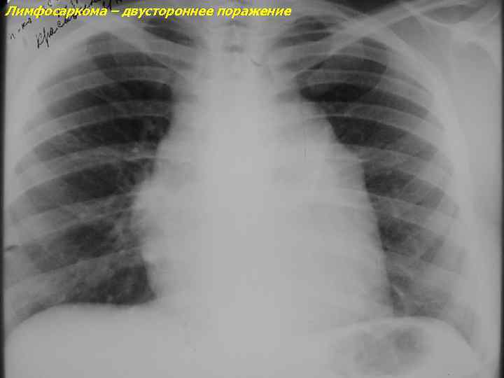 Лимфосаркома – двустороннее поражение 