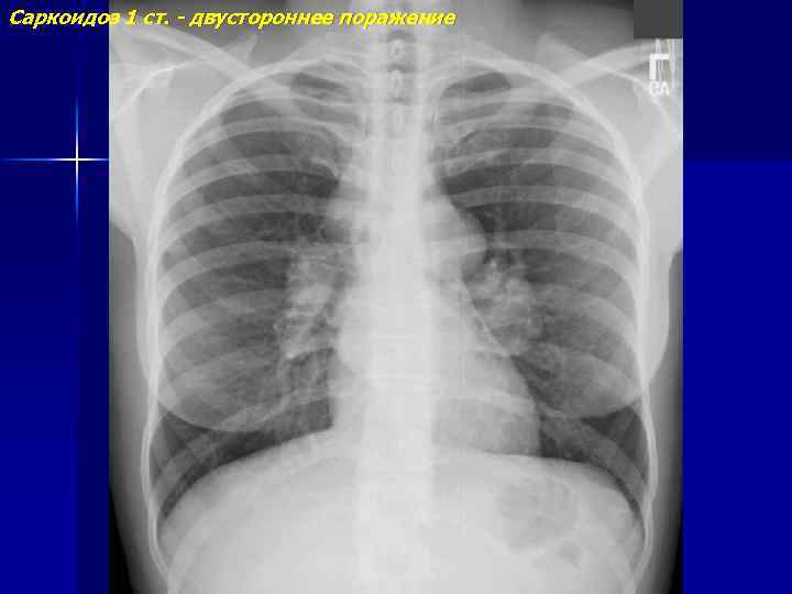 Саркоидоз 1 ст. - двустороннее поражение 
