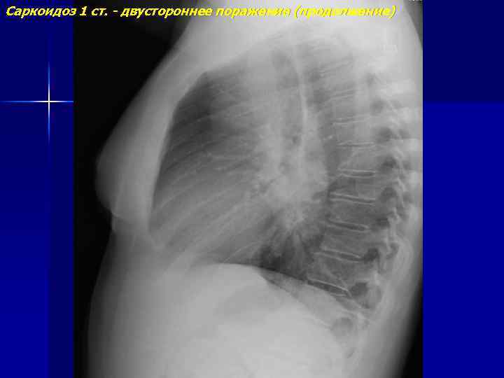 Саркоидоз 1 ст. - двустороннее поражение (продолжение) 