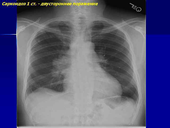 Саркоидоз 1 ст. - двустороннее поражение 