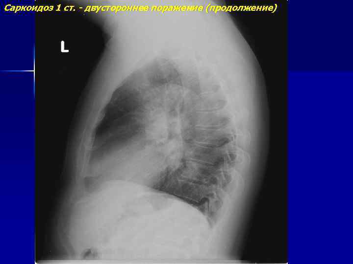 Саркоидоз 1 ст. - двустороннее поражение (продолжение) 