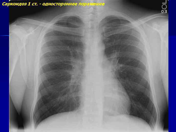 Саркоидоз 1 ст. - одностороннее поражение 