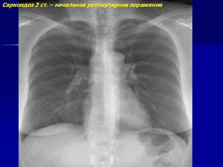 Саркоидоз 2 ст. – начальное ретикулярное поражение 