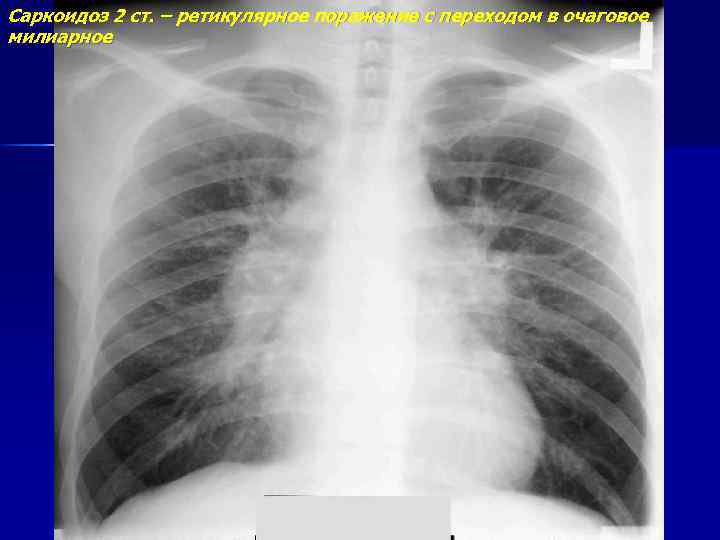 Саркоидоз легких на рентгене фото