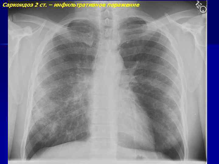 Саркоидоз 2 ст. – инфильтративное поражение 