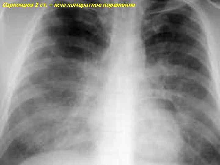 Саркоидоз 2 ст. – конгломератное поражение 