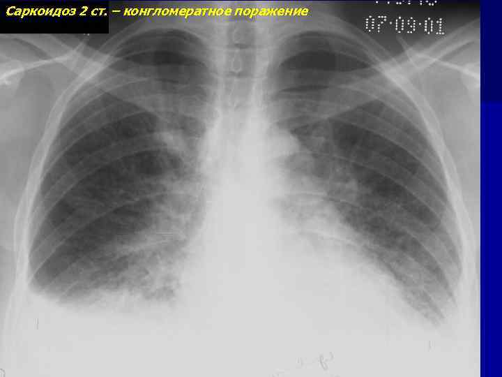 Саркоидоз 2 ст. – конгломератное поражение 