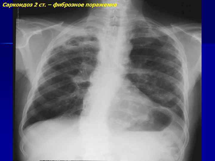 Саркоидоз 2 ст. – фиброзное поражение 