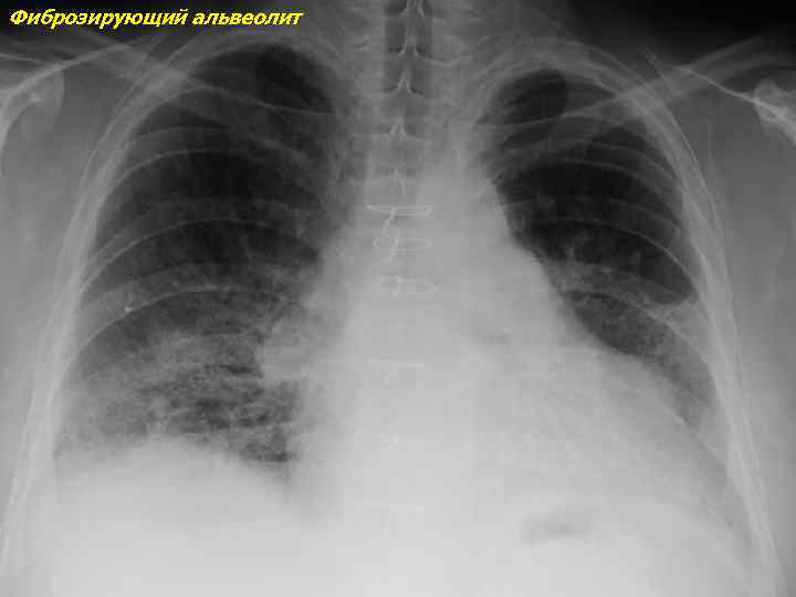 Макроскопическая картина легкого при фиброзирующих альвеолитах