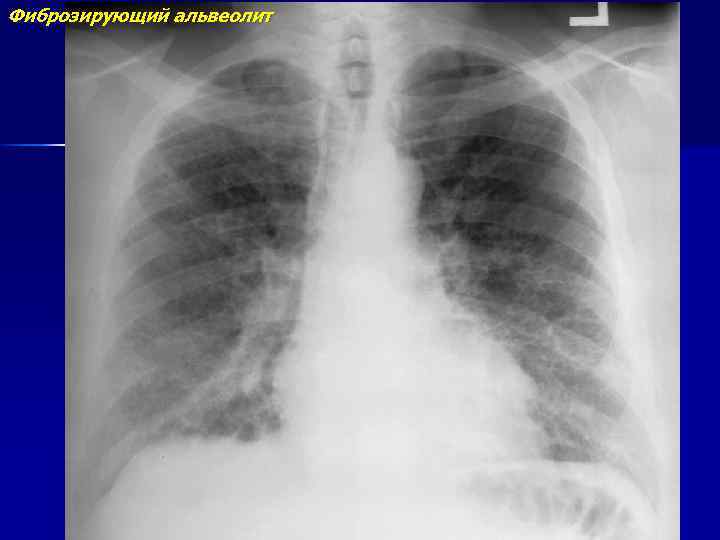 Макроскопическая картина легкого при фиброзирующих альвеолитах