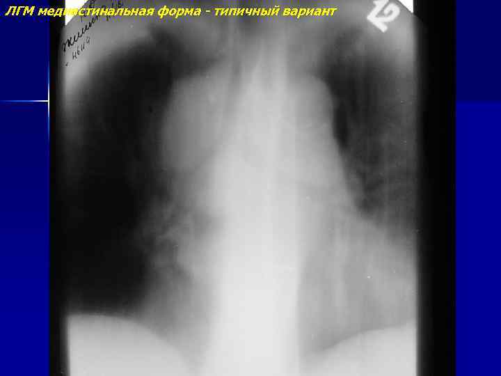 ЛГМ медиастинальная форма - типичный вариант 